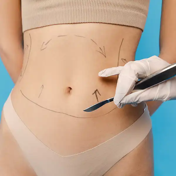 Abdominoplastie