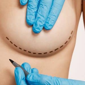 Augmentare mamară cu implant