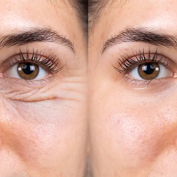 Blefaroplastie