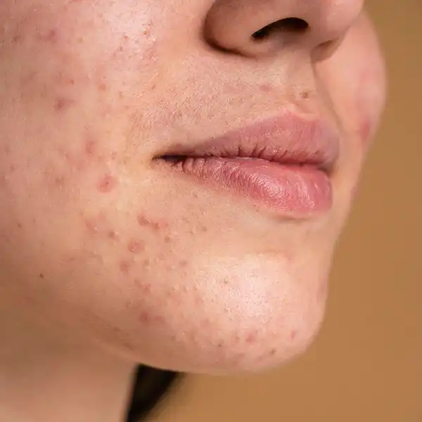 Cicatrici post-acneice