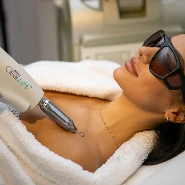 Îndepărtare tatuaj