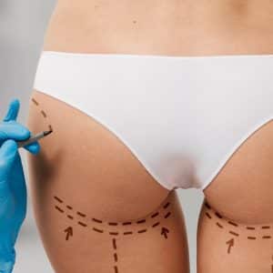 Lifting chirurgical fese