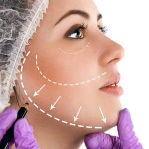 Minilifting facial