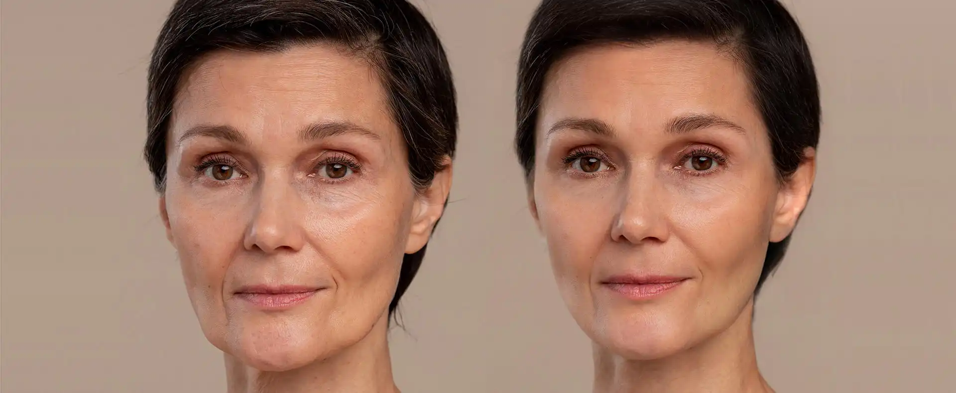 Sculptra