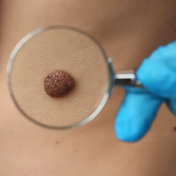 Analiză alunițe (nevi)