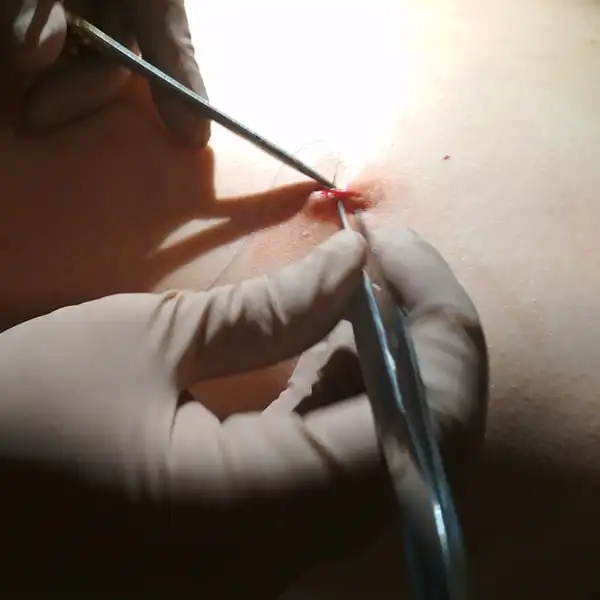 Crioterapie leziuni tegumentare